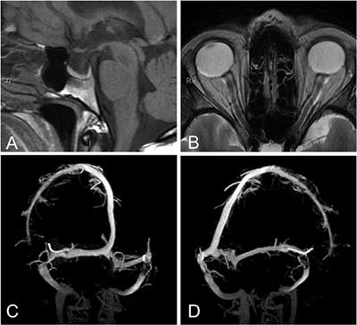 Idiopathic Intracranial Hypertension Without Papilledema (IIHWOP) in Chronic Refractory Headache